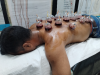 Hijama acupuncture treatment